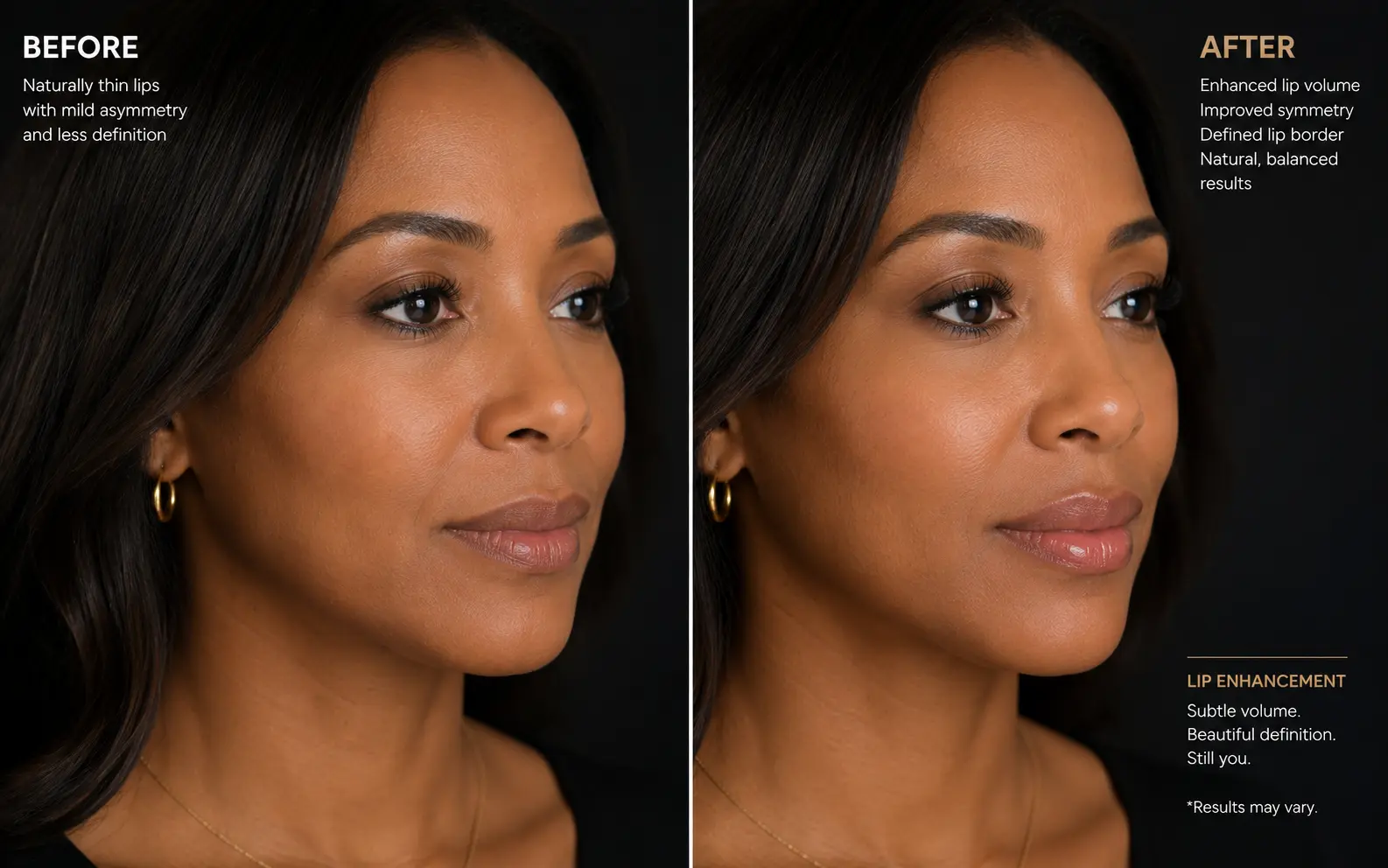 Before-and-after comparison of a woman's lips showing subtle added volume and clearer definition