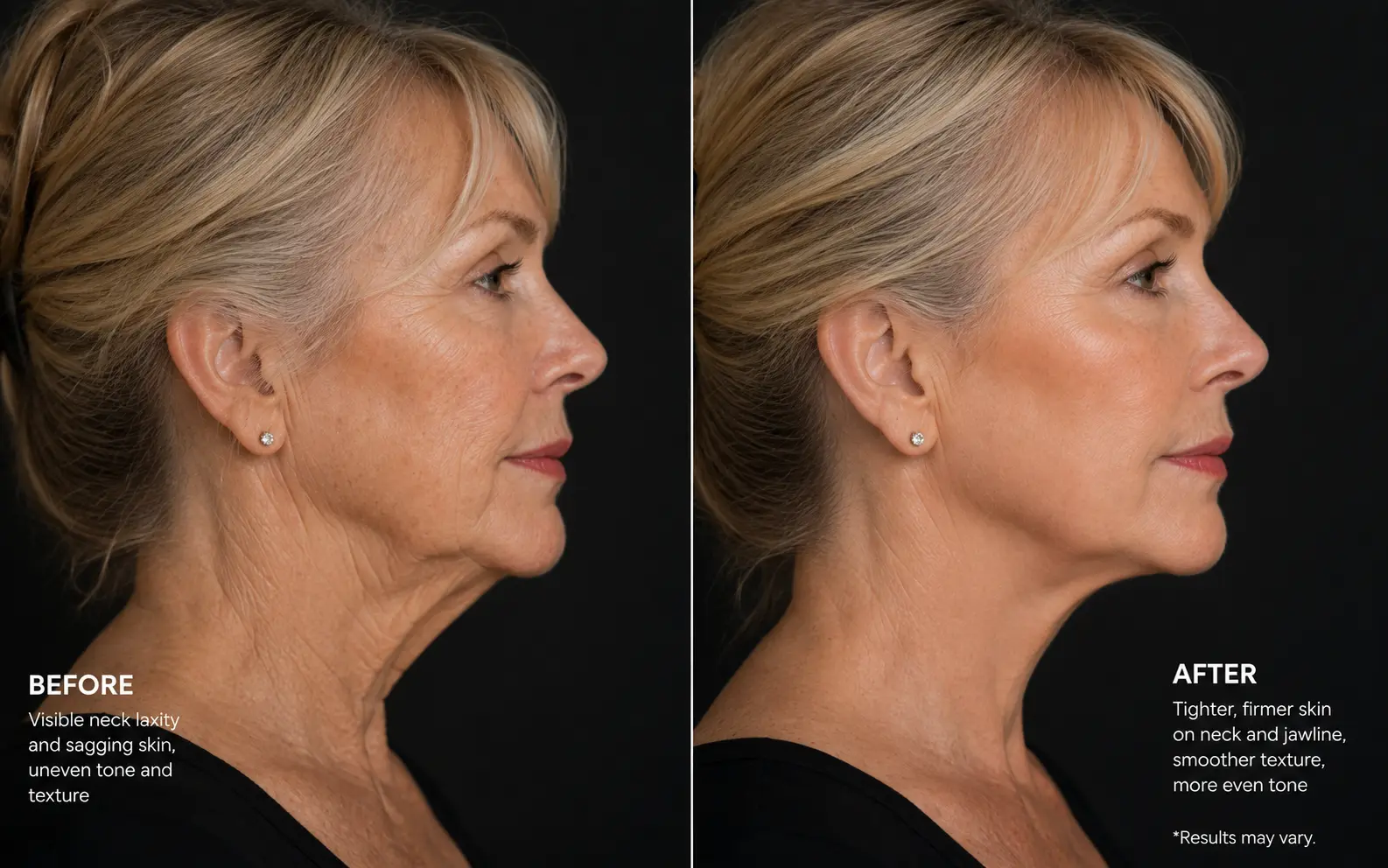 Before-and-after profile comparison of a woman's neck showing firmer-looking skin and smoother texture